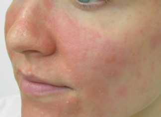 Facial Eczema Facial eczema