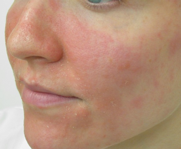 Mild Eczema On Face Symptoms