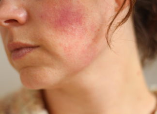 Red Blotches on Face Red Blotches on face