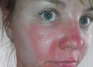 Facial Cellulitis Facial cellulitis picture