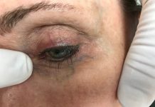 Am I at risk of varicose veins? Facial Veins