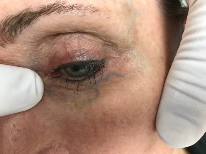 Facial Veins